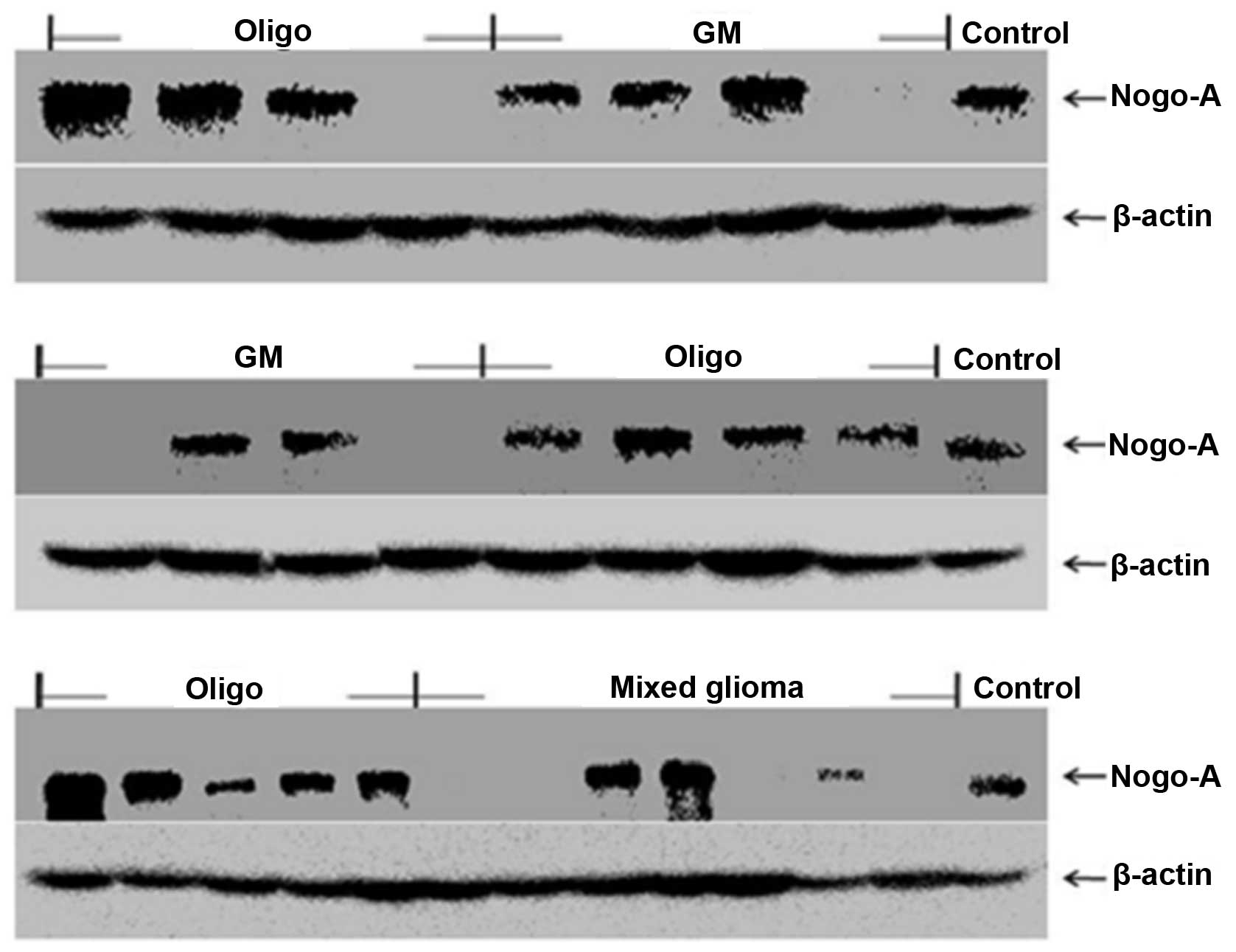 prins sikkerhed klar Nogo-A inhibits the migration and invasion of human malignant glioma U87MG  cells