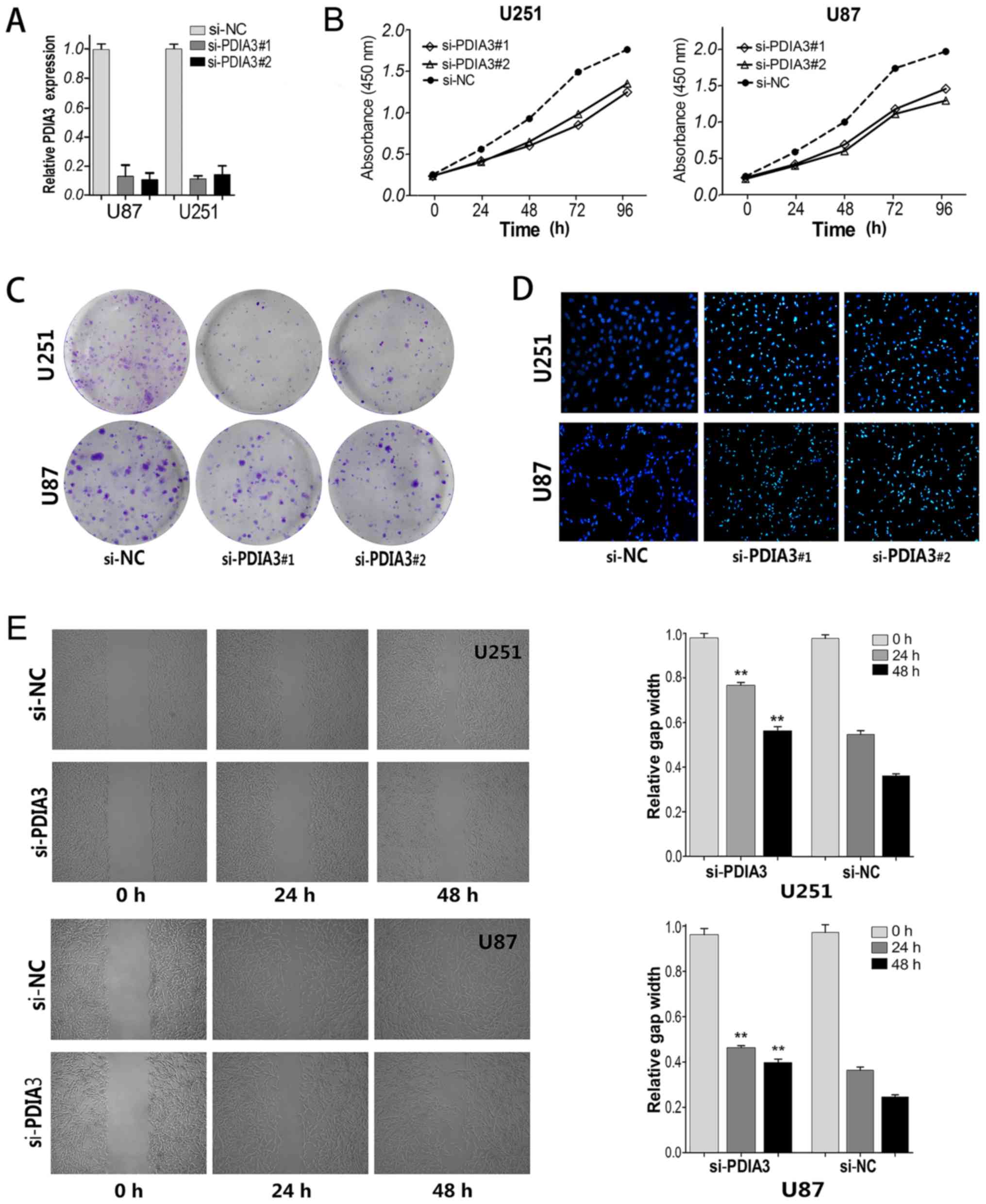 P4HB and PDIA3 are associated with tumor progression and