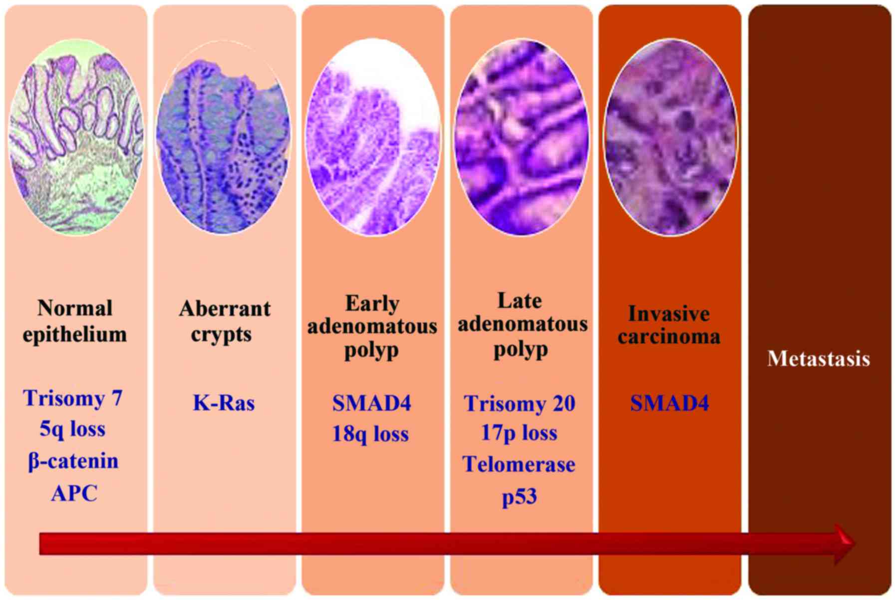 cancer colon progression anthelmintics ka meaning