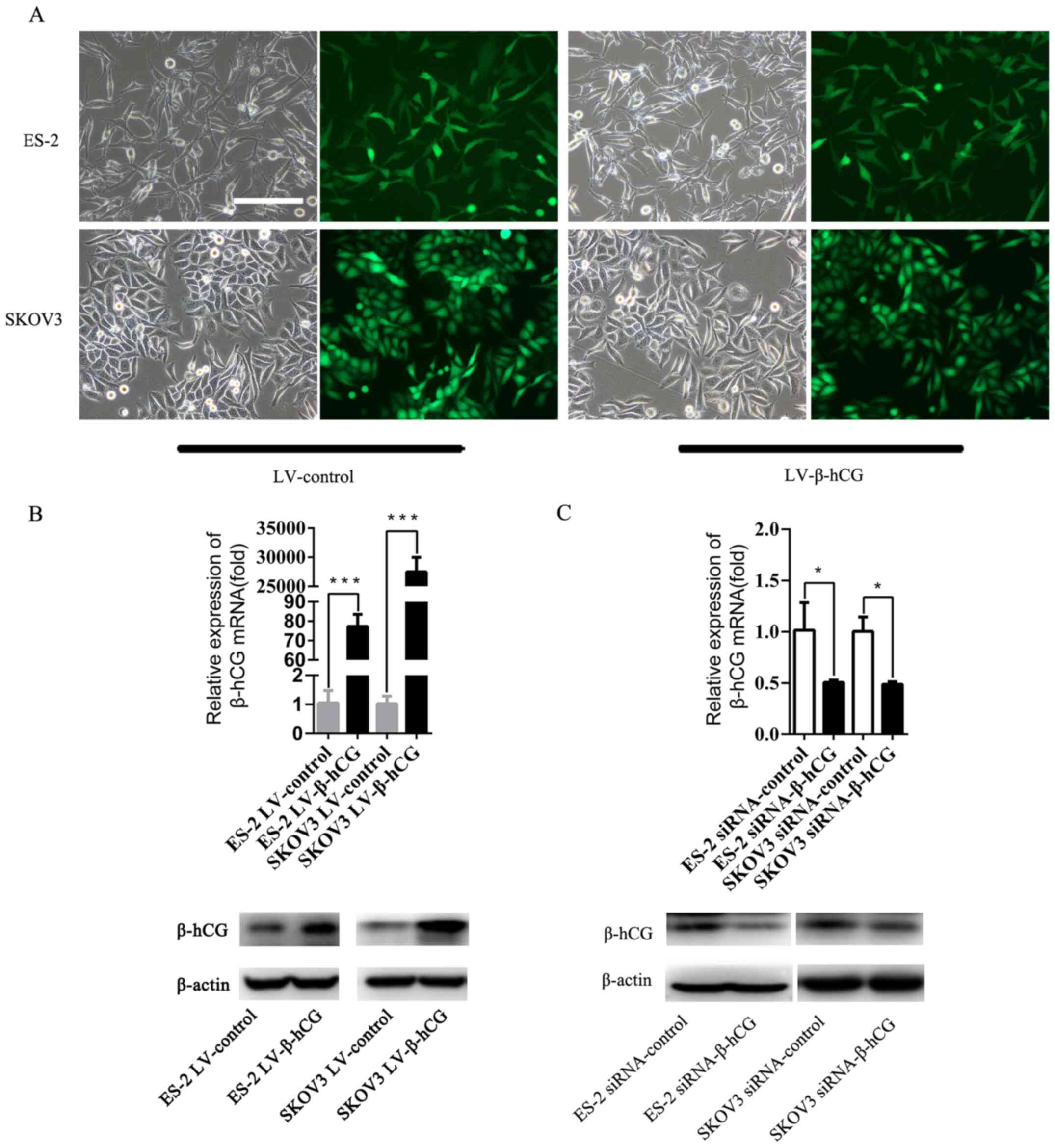 Successful construction of
β-hCG-overexpressing and -silenced ovarian cancer cell lines. (A)
ES-2 and SKOV3 cells were transfected with LV-vector or LV-β-hCG.
Cells were photographed under a fluorescence microscope, using both
light and fluorescence. Scale bar, 200 μm. (B) The relative
expression level of β-hCG mRNA in β-hCG-overexpressing ES-2 and
SKOV3 cells according to RT-PCR analysis and western blotting
(***P<0.001). (C) The relative expression level of β-hCG mRNA in
β-hCG-silenced ES-2 and SKOV3 cells was determined by RT-PCR
analysis and western blotting (*P<0.05).