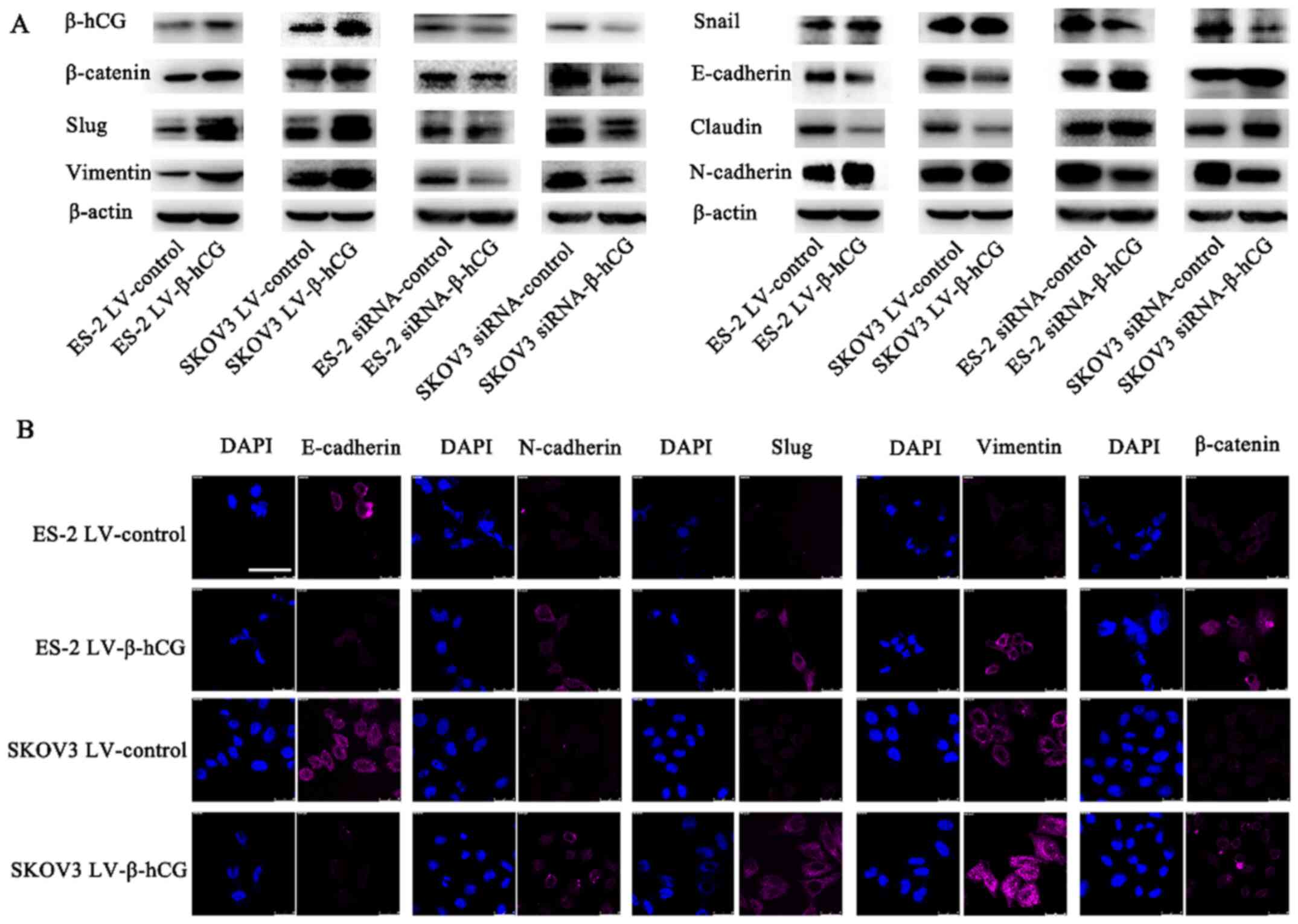 β-hCG induces EMT in ovarian cancer
cells. (A) Expression levels of EMT markers in ES-2 and SKOV3 cells
transfected with different reagents, as determined by western
blotting. (B) Immunofluorescence staining of EMT markers in
β-hCG-overexpressing and control cells pictured by laser scanning
confocal microscopy. Scale bar, 50 μm.