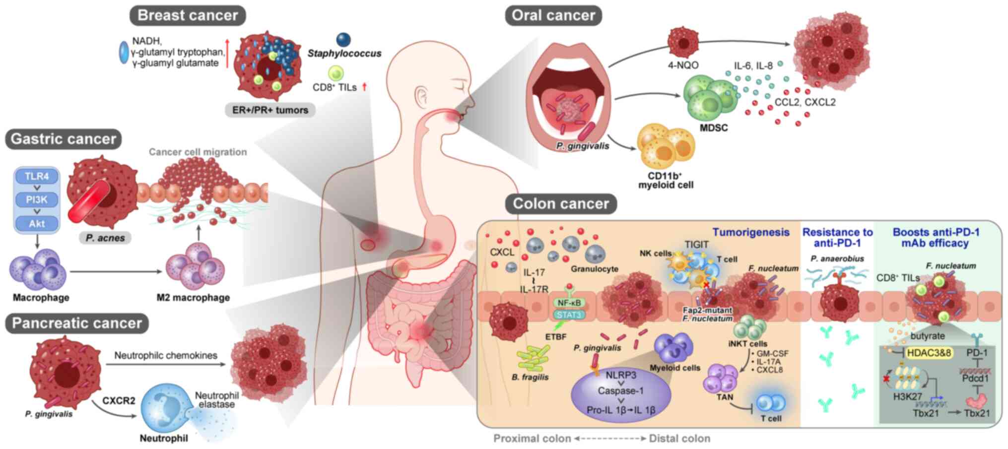 Illustration portraying the
intratumoral microbiome interacting with immune cells within the
tumor microenvironment. ETBF, enterotoxigenic Bacteroides
fragilis; 4-NQO, 4-nitroquinoline 1-oxide; ER, estrogen
receptor; GM-CSF, granulocyte-macrophage colony-stimulating factor;
HDAC, histone deacetylase; IL-17R, IL-17 receptor; iNKT, invariant
NK T; MDSC, myeloid-derived suppressor cell; NK, natural killer;
PD-1, programmed death-1; PR, progesterone receptor; TAN,
tumor-associated neutrophil; TILs, tumor-infiltrating lymphocytes;
TLR4, Toll-like receptor 4.