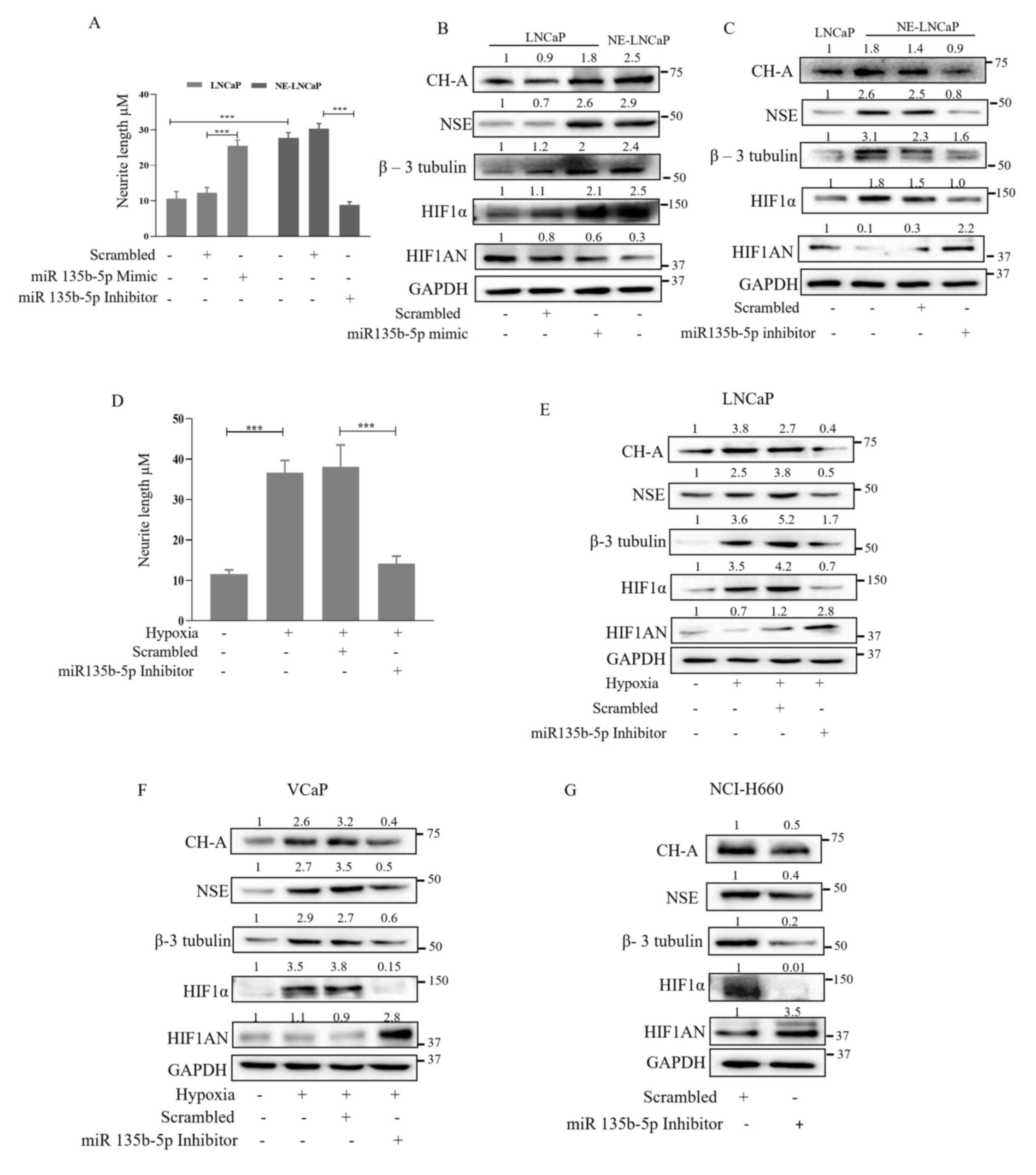 Inhibition of miR-135b-5p attenuates
the progression of NE prostate cancer. (A) LNCaP and NE-LNCaP cells
were transfected with a miR-135b-5p mimic or inhibitor, and neurite
outgrowth was determined by ImageJ. (B and C) Expression of NE and
a hypoxia-associated marker was evaluated by western blotting. (D)
LNCaP and VCaP cells were transfected with the miR-135b-5p
inhibitor under hypoxic conditions and neurite length was
determined by ImageJ. (E) Expression of NE and hypoxia-associated
markers was assessed by western blotting. (F and G) VCaP cells
under hypoxia and NCI-H660 cells were transfected with the
miR-135b-5p inhibitor, and the expression of NE and
hypoxia-associated markers was determined by western blotting. Data
are presented as the mean ± SD from three independent experiments.
***P<0.001. NE, neuroendocrine; miR, microRNA; HIF1α, hypoxia
inducible factor alpha-1; HIF1AN, hypoxia inducible factor alpha-1
subunit alpha inhibitor; CH-A chromogranin A.