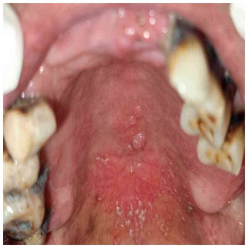 Human Papillomavirus And Oral Manifestations In A Patient With Hiv A Case Report And Literature