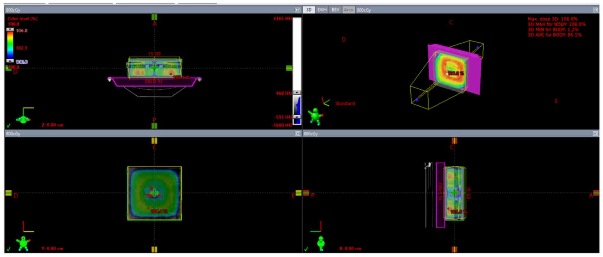 Computed tomography images of the
complete setup that were imported to the treatment planning
system.