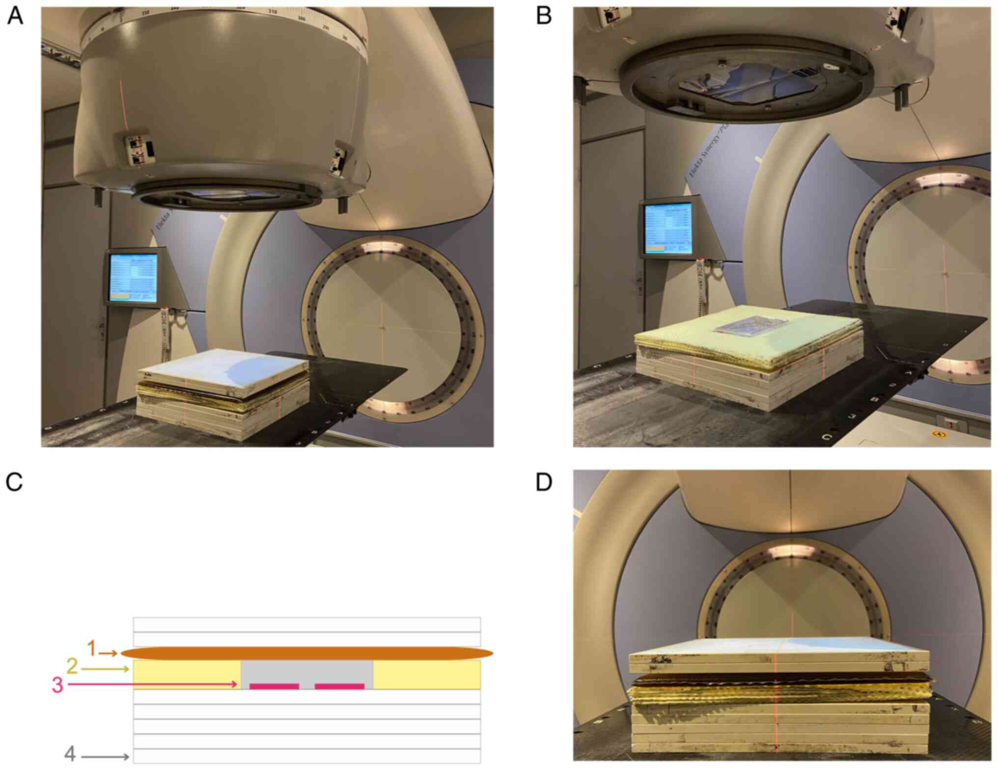 The setup used for irradiations. (A)
Complete setup from top to bottom, consisting of two 1 cm-thick
solid water plates, a 1 cm-thick gel bolus, a 2 cm-thick custom
thermoplastic support holding a 6-well culture plate, and five
additional 1 cm-thick solid water plates. The total setup height
was 10 cm, with an SSD of 95 cm, so that the cells are at the
isocenter, at a depth of 5 cm in both directions
(anteroposterior/posteroanterior). (B) Open view of the setup,
highlighting the cell culture plate positioned at the isocenter,
and the opening of the radiation field. (C and D) Schematic
cross-sectional illustration of (C) the setup. 1, gel bolus; 2,
custom thermoplastic support; 3, culture plate; 4, solid water
plates. (D) Image alongside the actual setup.