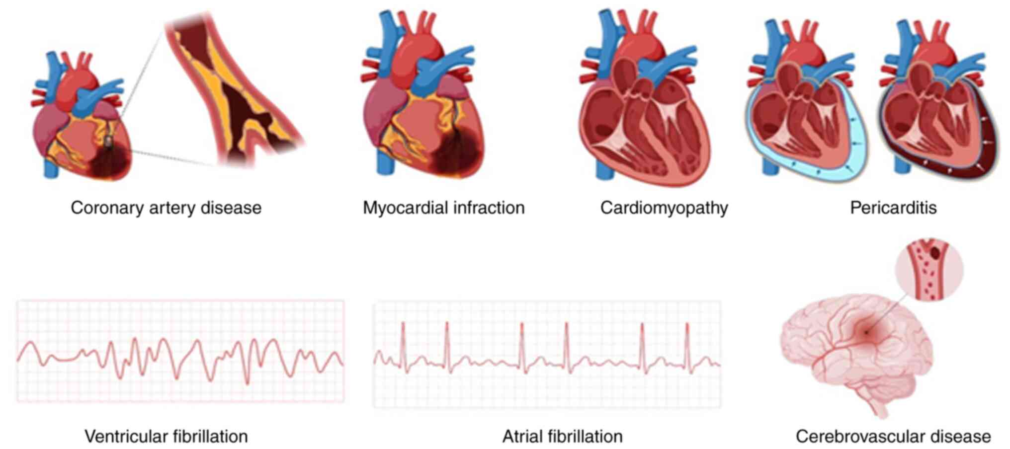 Major cardiovascular diseases.
